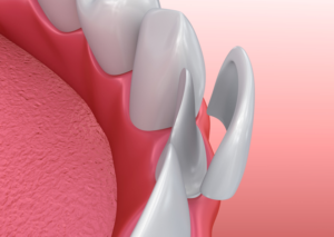 Veneer in front of lower tooth